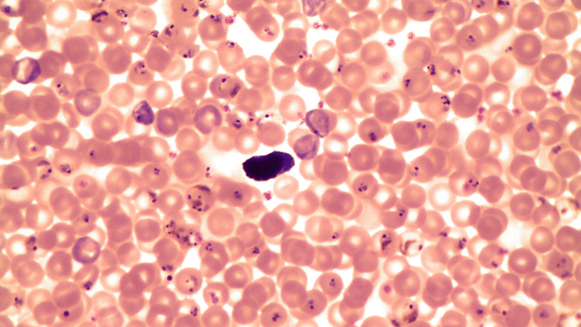 Malaria serum as seen through microscope